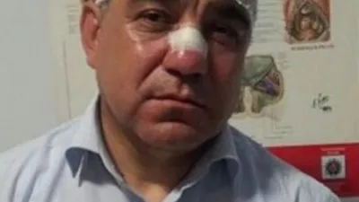 Vekilin burnunu kıran polise ceza !
