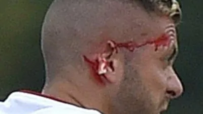 Jeremy Menez'in kulağı koptu !