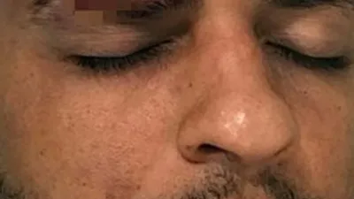 Melo'nun kaşı açıldı ! Şok görüntü...