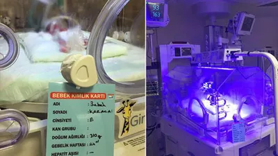 Tuğra bebek 310 gram doğdu