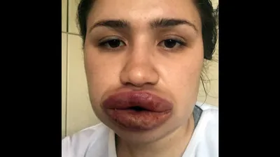 Dudaklarıyla tanınmıştı... İşte son hali !