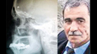 Bitmek bilmez baş ağrılarının sebebini öğrenince şoke oldu