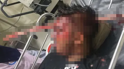 Kafasına saplanan demirle hastaneye gitti