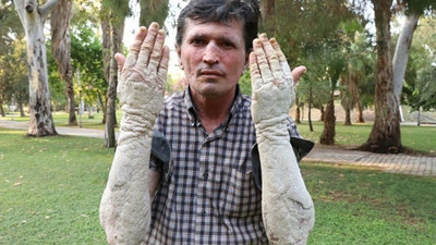 23 yıldır kabusu yaşıyor; insanlar onu görünce kaçacak yer arıyor