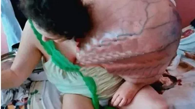 Omzundaki tümör kendi ağırlığını geçti!