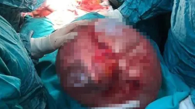 Karın ağrısıyla gitti 13 kiloluk kitle çıkarıldı