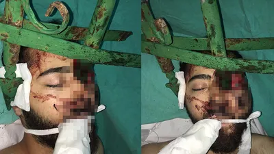 Yüzüne demir saplanmıştı... Emre'den haber var !