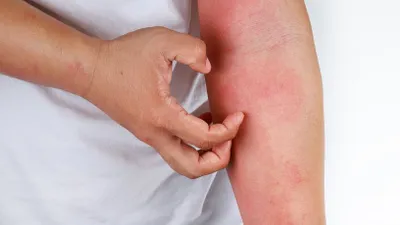 Bu belirtiler varsa dikkat! İstanbul'da yeni salgın alarmı