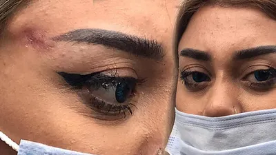 Bir estetik kurbanı daha! ''2 haftadır uyku uyuyamıyorum''