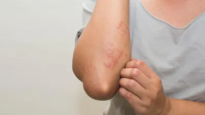 Aşırı kolonya ve dezenfektan kullanımında egzama tehlikesi