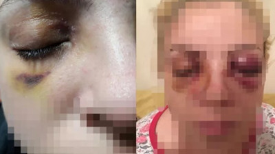 Dehşet anlarını anlattı ! Diş fırçasıyla gözlerini oymaya çalıştı