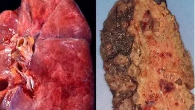 Koronavirüsün akciğerlere verdiği hasarın en net görüntüsü