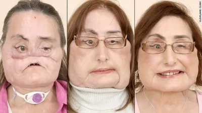 Yüz nakli yapılan kişi öldü