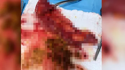 Karnından çıkanlar doktorları bile şoke etti!