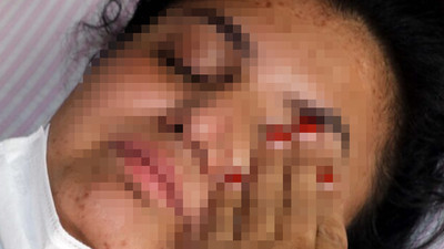 Eşi tarafından 6 kurşunla yaralanmıştı: 22 yaşındaki Kadriye felç kaldı