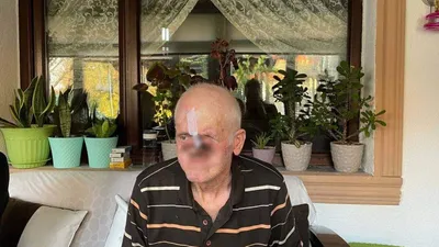Sivilce deyip geçmeyin! Sadece bir sivilce ile başladı; burnunu kaybetti