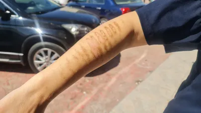 Yine güzellik merkezi yine facia! Kolları bu hale geldi