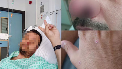 Dünyanın konuştuğu Türk: Önce HIV ve koronavirüsü sonra da maymun çiçeğini yendi