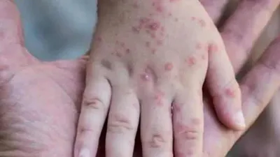 Maymun çiçeği virüsü bir can daha aldı! O ülkedeki ilk ölüm