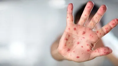 Maymun çiçeği virüsü bir can daha aldı