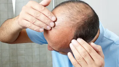 Bilim insanları sonunda kelliğin ilacını buldu