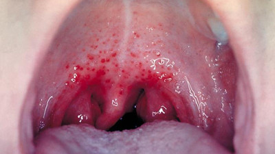 Strep A kabusu büyüyor: 122 kişi hayatını kaybetti