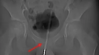 12 yaşındaki çocuğun cinsel organından çıktı! Doktorlar şaşkına döndü