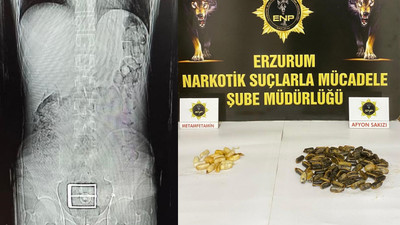 Yabancı uyruklunun midesinden çıkanlar şoke etti