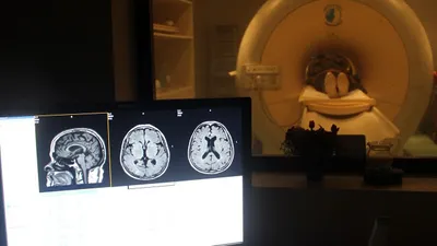 80 yıl boyunca beynindeki iğneyle yaşamış