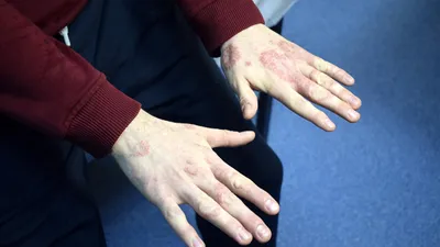 Egzama kabusu sona erdi: Artık kesin tedavisi var