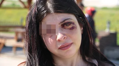 Genç kadın sokak ortasında dehşeti yaşadı! Ömür boyu böyle yaşayacak...