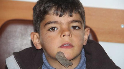 Çenesinde tümör olan çocuğa yardım eli