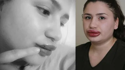 Silikon mağduru genç hemşireden haber var