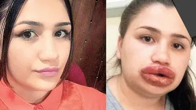 Dudağına yaptırdığı estetik hayatını kabusa çevirdi