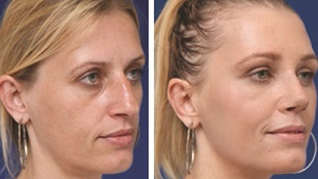 Orumcek Agi Estetiginde Merdiven Alti Uygulamalara Dikkat Saglik