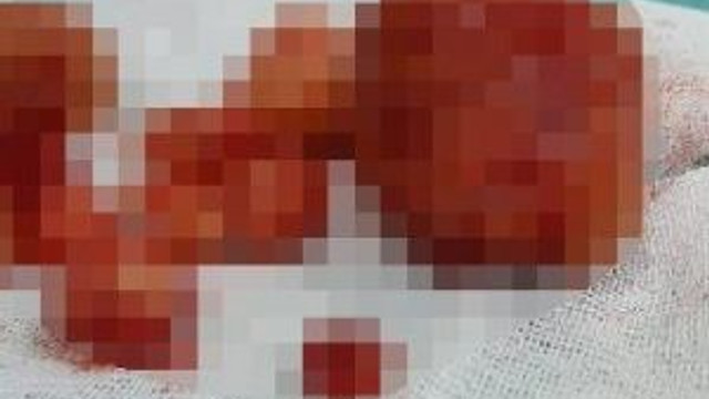 Hastaneye Cocugum Olmuyor Diye Gitti Rahminden 1 Kilo Ur Cikti Saglik