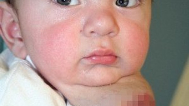 pisik sandilar damar yumagi olustu kadin