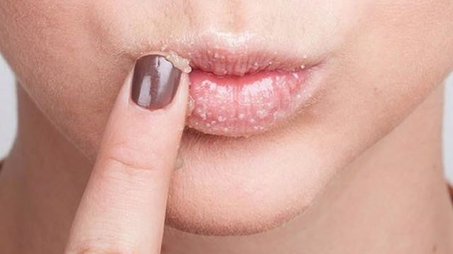 agiz yarasi nedenleri saglik