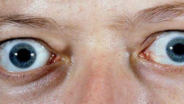 graves hastaligi belirtileri saglik