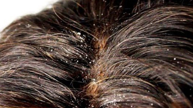 kepek belirtileri saglik