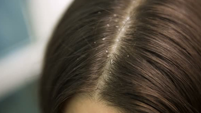 kepek nedenleri saglik