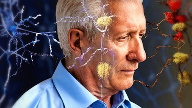 Bilim insanları Alzheimer'a ''genetik çözüm'' buldu !