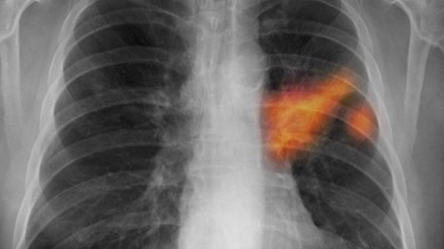 akciger odemi belirtileri saglik