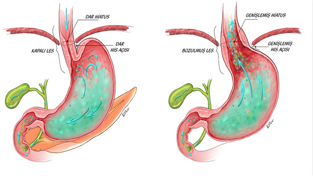 alkalen reflu gastrit nedenleri saglik