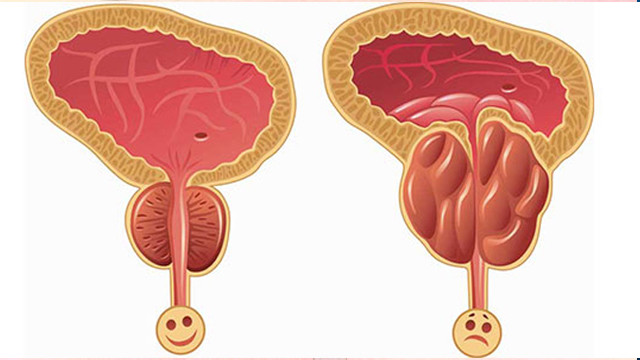 prostatit prostat iltihabi nedenleri