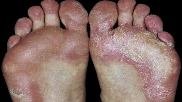 Ayak Mantari Belirtileri Saglik