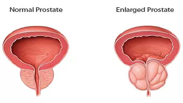 Kronik Prostatit Belirtileri