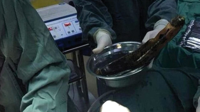 Karın ağrısıyla hastaneye giden adamın anüsünden patlıcan çıktı !
