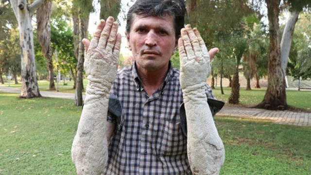 23 yıldır kabusu yaşıyor; insanlar onu görünce kaçacak yer arıyor