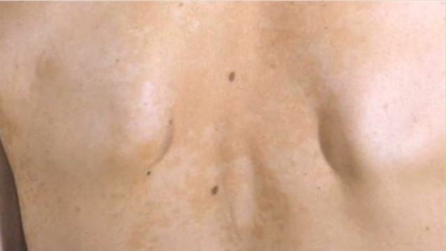 Cilt Mantari Belirtileri Saglik